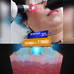 TRỊ NÁM  TÀN NHANG GIÁ TỐT chỉ có ở Kangnam