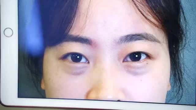 Đẹp miễn chê với kết quả cắt mí OPEN DEEP 5D sau 7 ngày