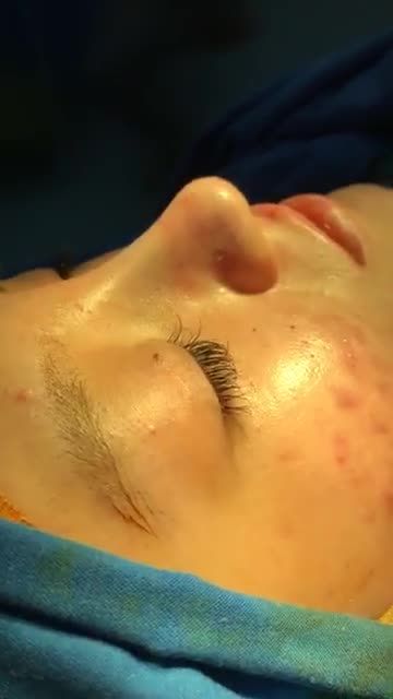 Nâng mũi Bán Cấu Trúc Sụn Tai 2 Lớp cho em gái tuổi đôi mơi ở Sadec