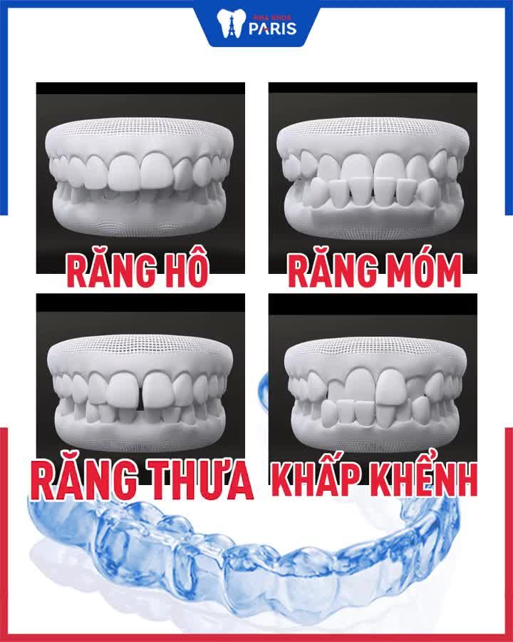 NIỀNG RĂNG TRONG SUỐT  CHỈ TỪ 34 TRIỆU  DUY NHẤT TP HCM