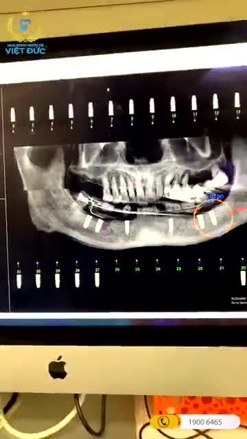 Cấy Implant toàn bộ hàm dưới cho bệnh nhân tim mạch tại Nha khoa Quốc tế Việt Đức cơ sở 84A, Hai Bà Trưng