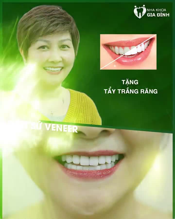 DÁN SỨ VENEER – TỎA SÁNG NỤ CƯỜI VIỆT TẠI TRỜI ÂU