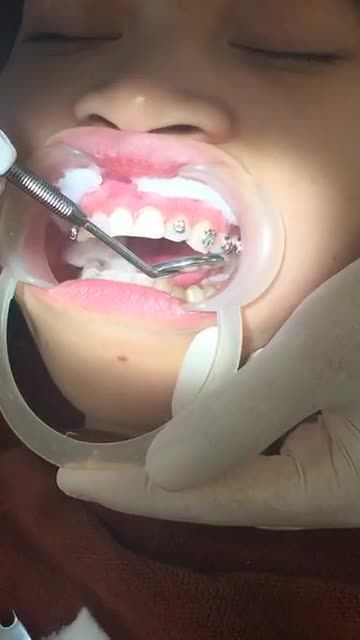 GẮN MẮC CÀI NIỀNG RĂNG HÔ + KHẤP KHỂNH tại Nha Khoa Vân Anh !!!