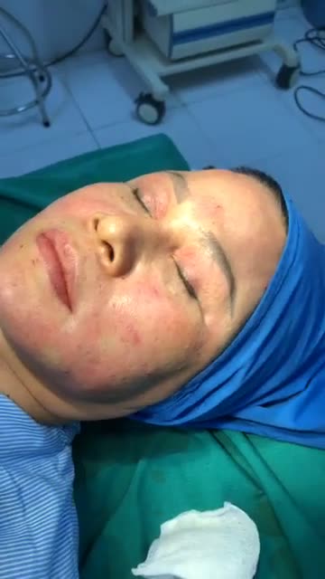 Ghép Mỡ Mặt BaBy
