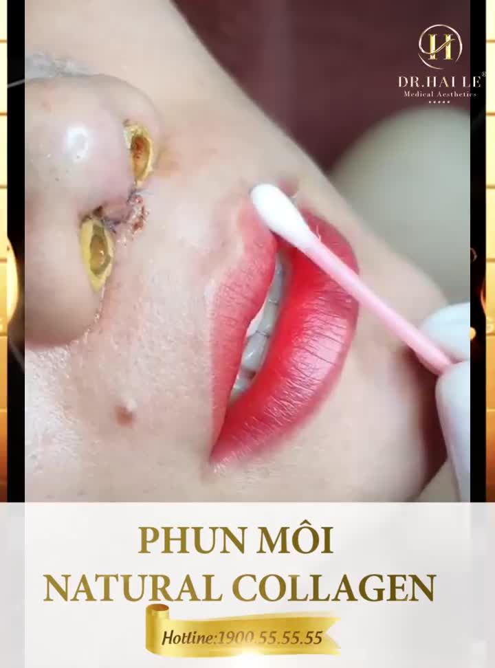 Nhiều chị em thắc mắc tại sao PHUN MÔI NATURAL COLLAGEN tại Dr.Hải Lê lại HOT đến như vậy.
