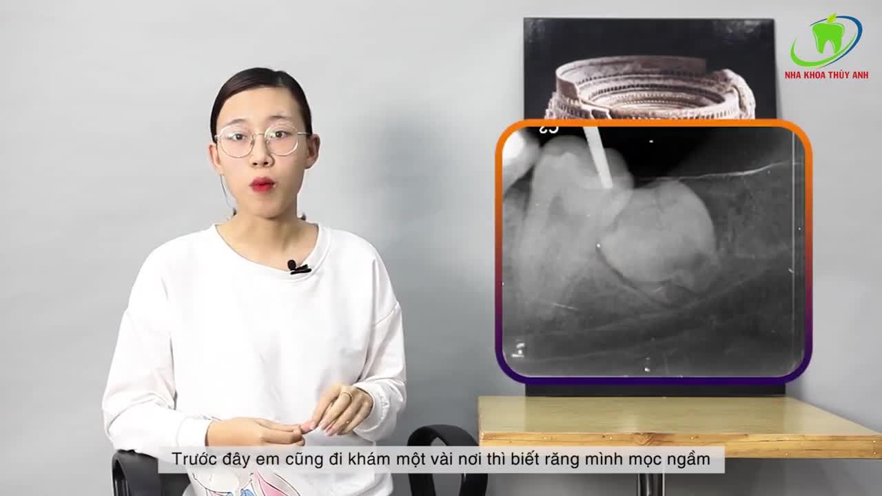 NHỔ RĂNG KHÔN MỌC LỆCH - NGẦM KHÔNG ĐAU, KHÔNG CHẢY NHIỀU MÁU? BÍ QUYẾT LÀ GÌ?