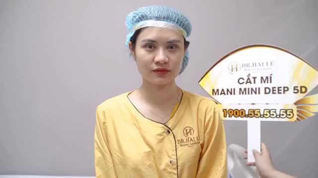Cận cảnh đôi mắt sau khi cắt mí Mani Mini Deep 5D, bỏ qua chắc chắn bạn sẽ tiếc "hùi hụi"