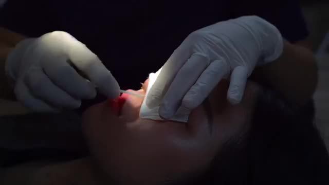 Cắt chỉ sau nâng mũi có đau không?,lắng nghe review từ chính người trong cuộc.