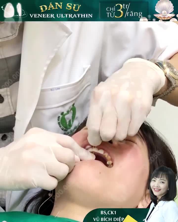 DÁN SỨ VENEER – GIẢI PHÁP HOÀN HẢO CHO NỤ CƯỜI ĐẸP MÃI VỚI THỜI GIAN
