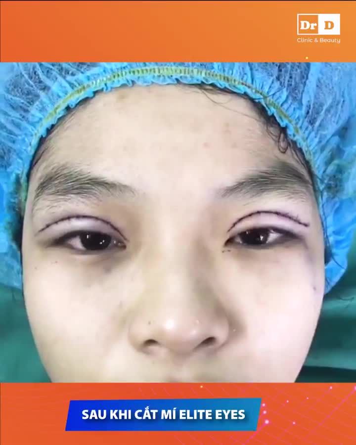 ĐÔI ĐIỀU CHIA SẺ VỀ DỊCH VỤ CẮT MÍ ELITE EYES