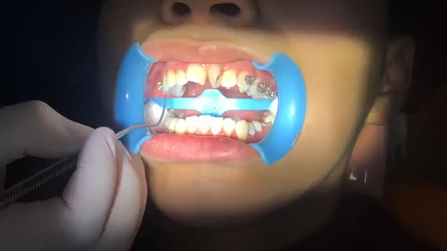GẮN MẮC CÀI NIỀNG XOAY + KHẤP KHỂNH tại Nha Khoa Vân Anh !