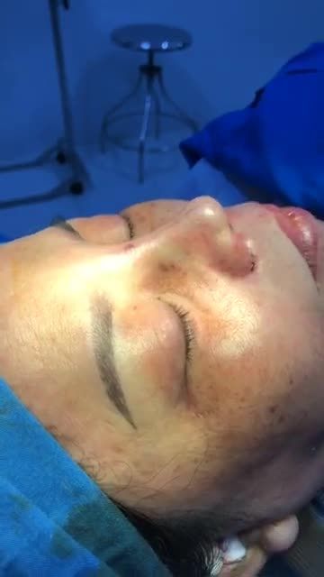 Nâng mũi Bán Cấu trúc sụn tai 2 lớp + thu cánh mũi Plasma