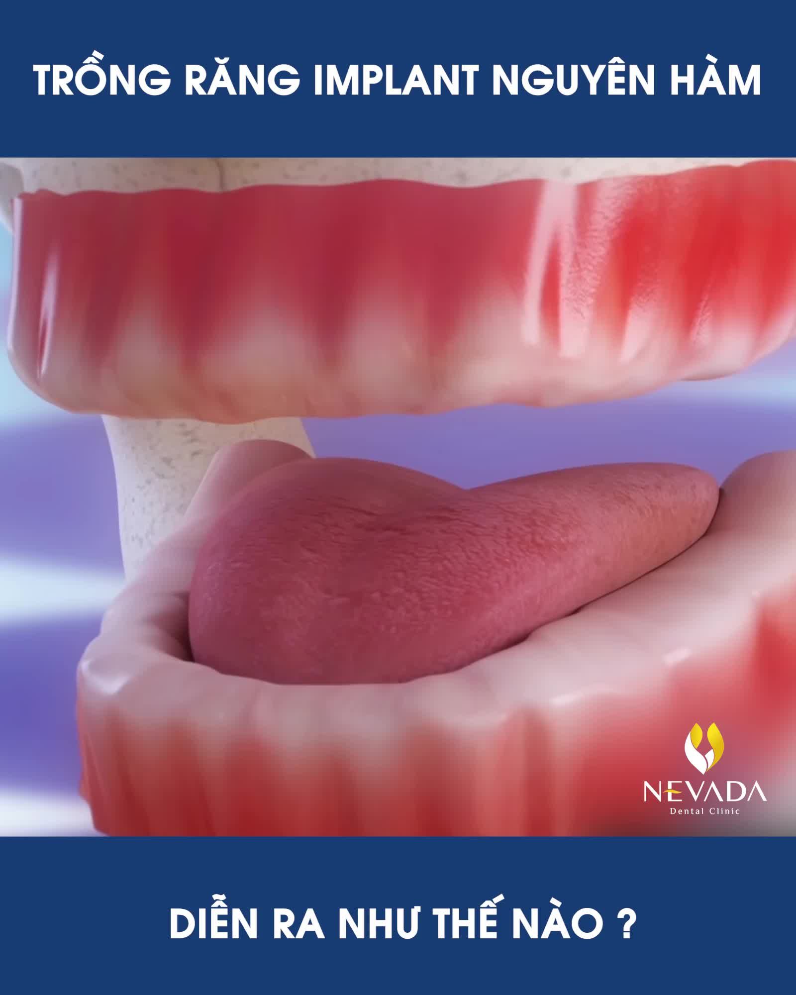 TRỒNG RĂNG IMPLANT NGUYÊN HÀM - GIẢI PHÁP PHỤC HÌNH RĂNG HOÀN HẢO