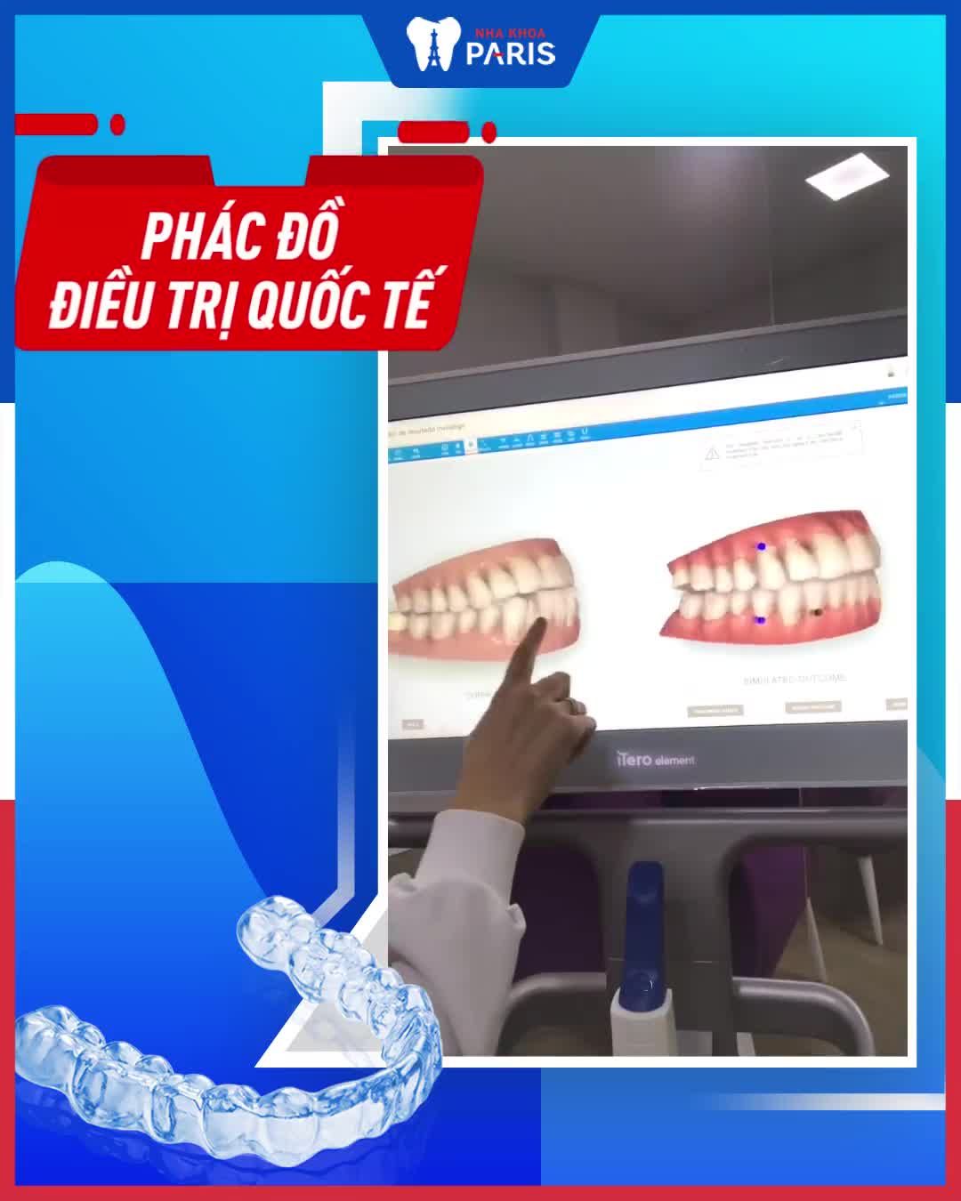 NIỀNG RĂNG TRONG SUỐT CHỈ TỪ 34TR GIÁ TỐT NHẤT HÀ NỘI
