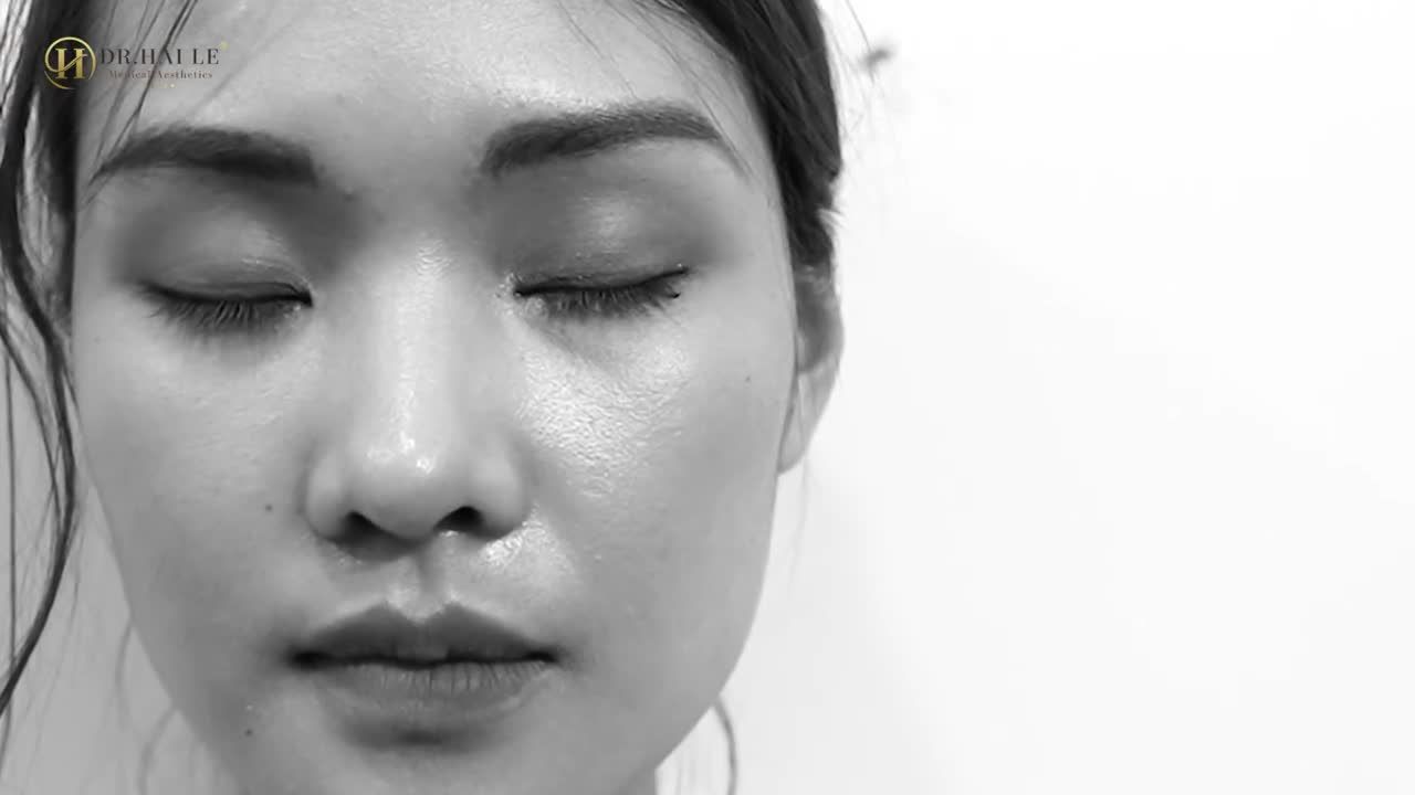 "Hồi hộp chờ đến ngày cắt mí và cái kết đẹp ngỡ ngàng"