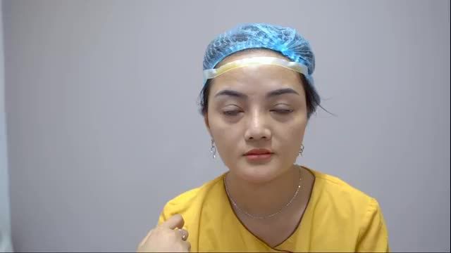 Kết quả cắt mí đẹp hoàn hảo ngay sau khi vừa phẫu thuật, khắc phục hoàn toàn tình trạng sụp mí u buồn. ĐỪNG BỎ LỠ