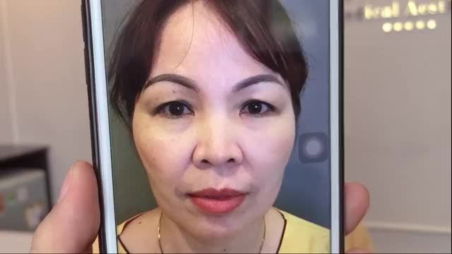 1 ca Nâng cung mày giúp thay đổi tới 70% nhan sắc ngay khi còn trên bàn phẫu thuật.