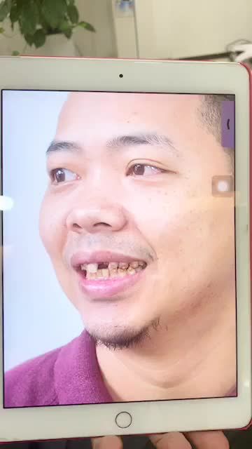 MẤT RĂNG CỬA KHẮC PHỤC NHƯ THẾ NÀO?