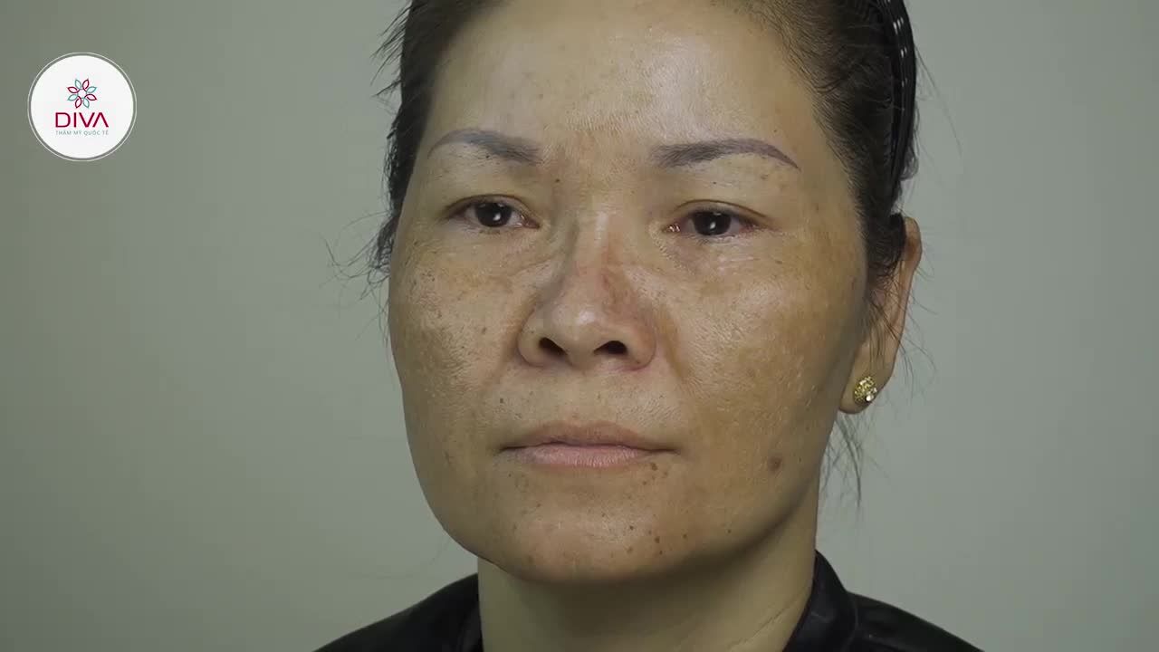 NÁM DA HƠN 20 NĂM – CẢI THIỆN ĐẾN 90% SAU 3 THÁNG ĐIỀU TRỊ