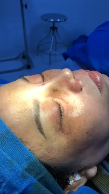 Nâng Mũi Bán Cấu Trúc và thu cánh mũi Plasma