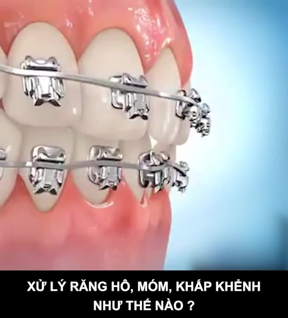 Ở TP HỒ CHÍ MINH THAY ĐỔI HÀM RĂNG LỆCH LẠC Ở ĐÂU?