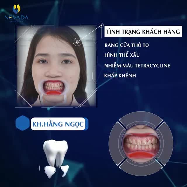 RẠNG NGỜI NHAN SẮC CÙNG THẨM MỸ RĂNG SỨ INVY ULTRA 3P