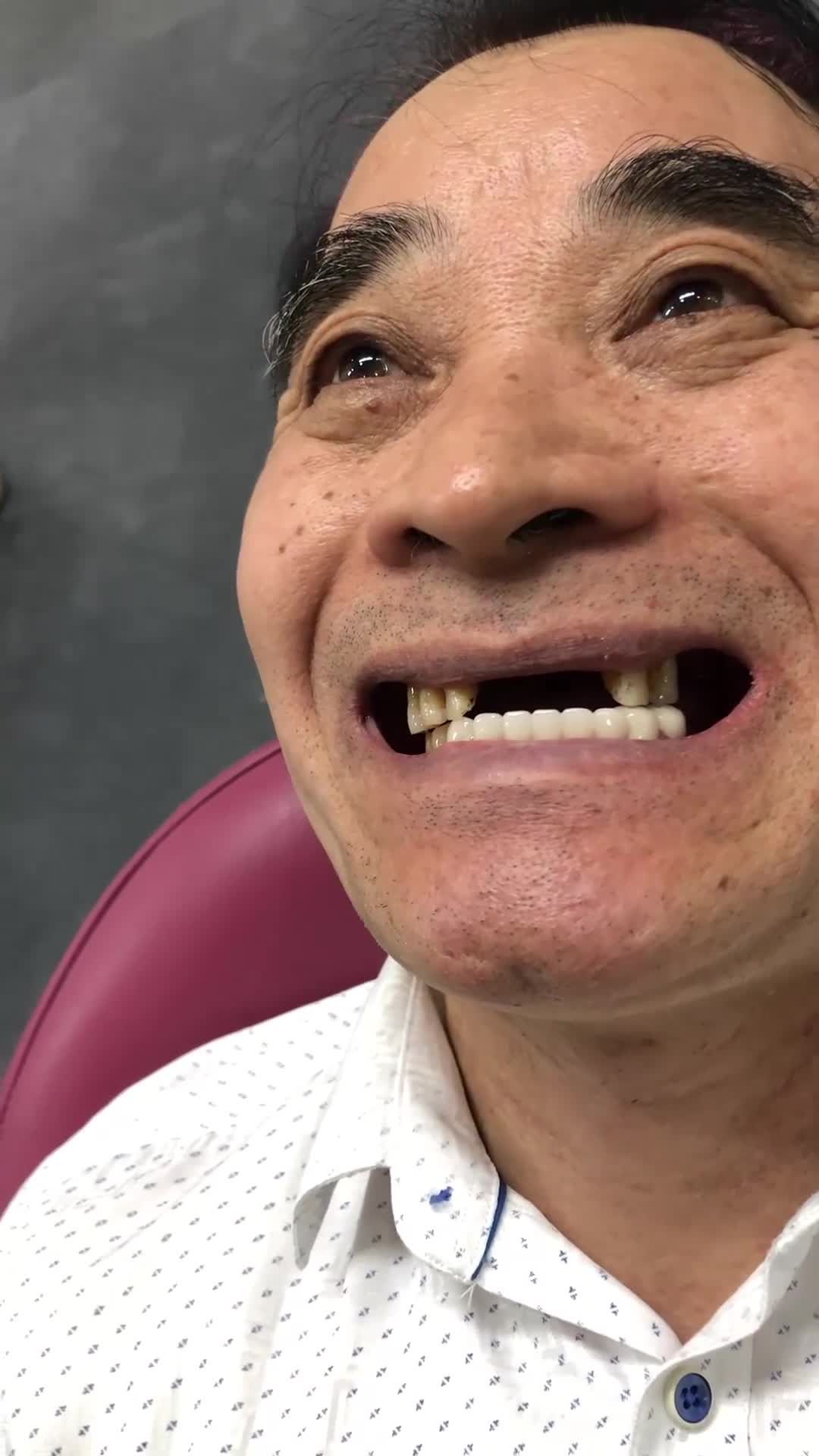 TOÀN CẢNH CẮM VÍT 5 RĂNG IMPLANT