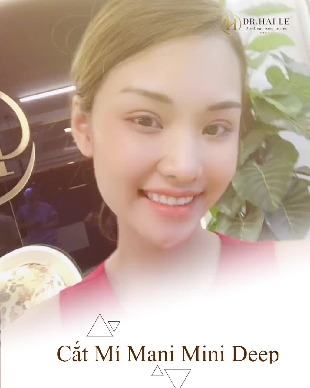Đốn Tym với góc nhìn “Thần thánh” sau Cắt mí!