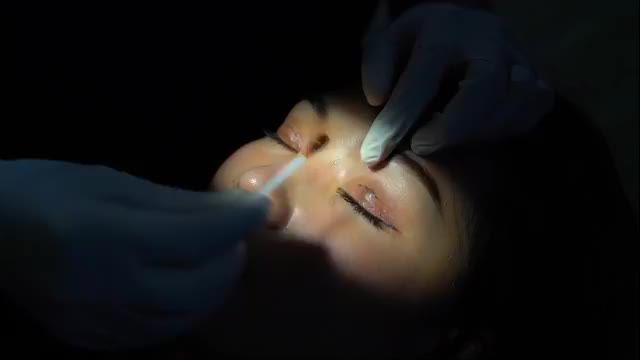 Quá trình cắt chỉ mí Mani Mini Deep 5D sau 7 ngày
