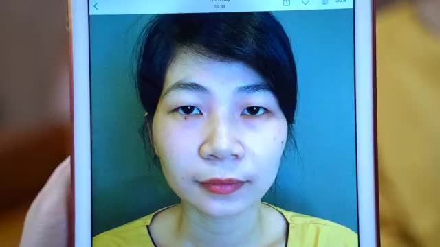 Kết quả 1 ca cắt mí Mani Open Deep 5D đẹp mê li của chị gái đến từ nghệ An. XEM NGAY KẺO LỠ!