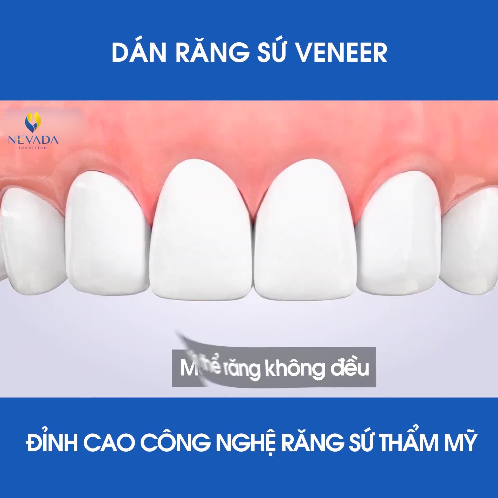 DÁN SỨ VENEER - ĐỈNH CAO CÔNG NGHỆ RĂNG SỨ THẨM MỸ
