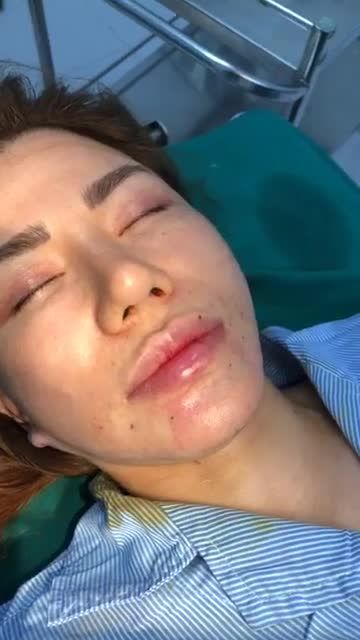 Ghép mỡ mặt baby vùng cằm, khoé môi...