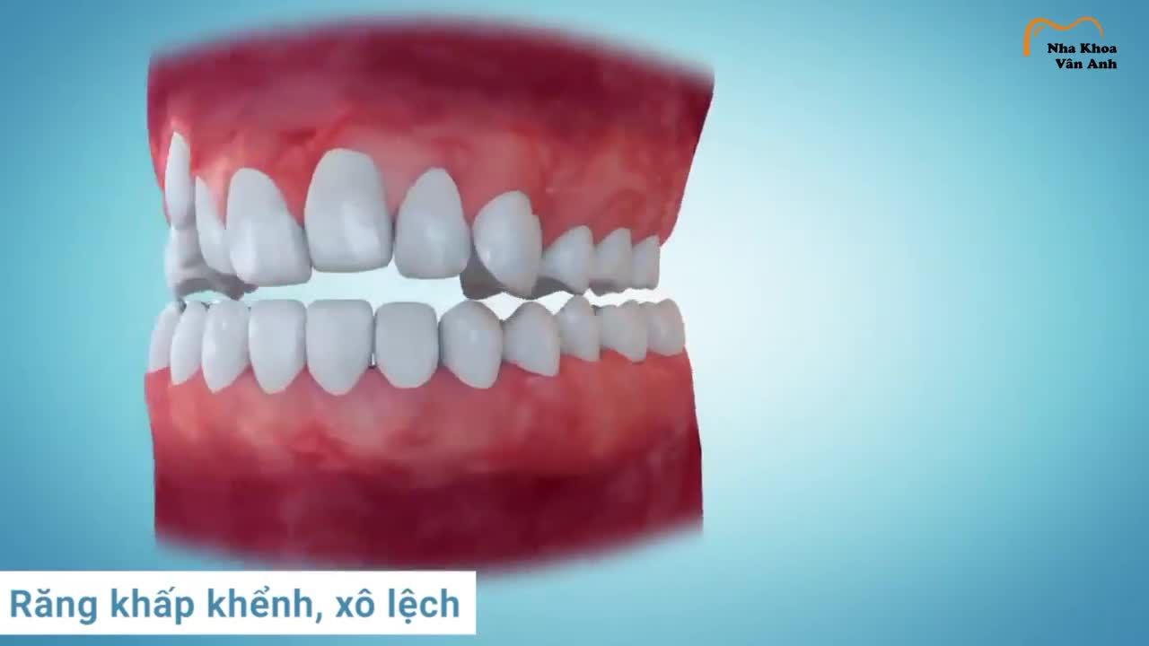 TẠI SAO 90% KHÁCH HÀNG LỰA CHỌN MẮC CÀI TỰ BUỘC?