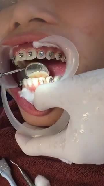 GẮN MẮC CÀI HÔ + KHẤP KHỂNH tại Nha Khoa Vân Anh