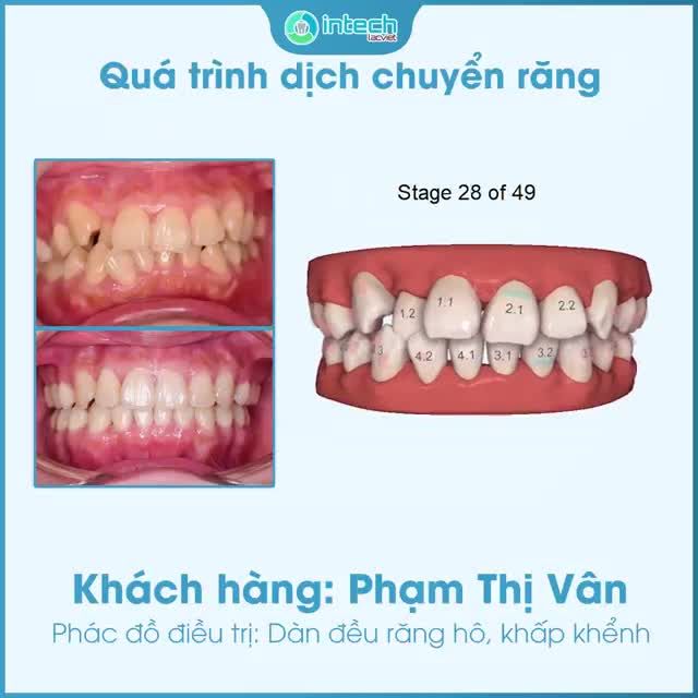 HÔ BIẾN RĂNG KHẤP KHỂNH NẶNG ĐỀU ĐỀU SAU 18 THÁNG VỚI INVISALIGN