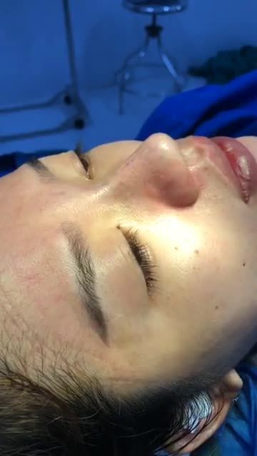 Nâng mũi Ban Cấu trúc Sụn Tai 2 lớp và Bóp nhỏ đầu mũi