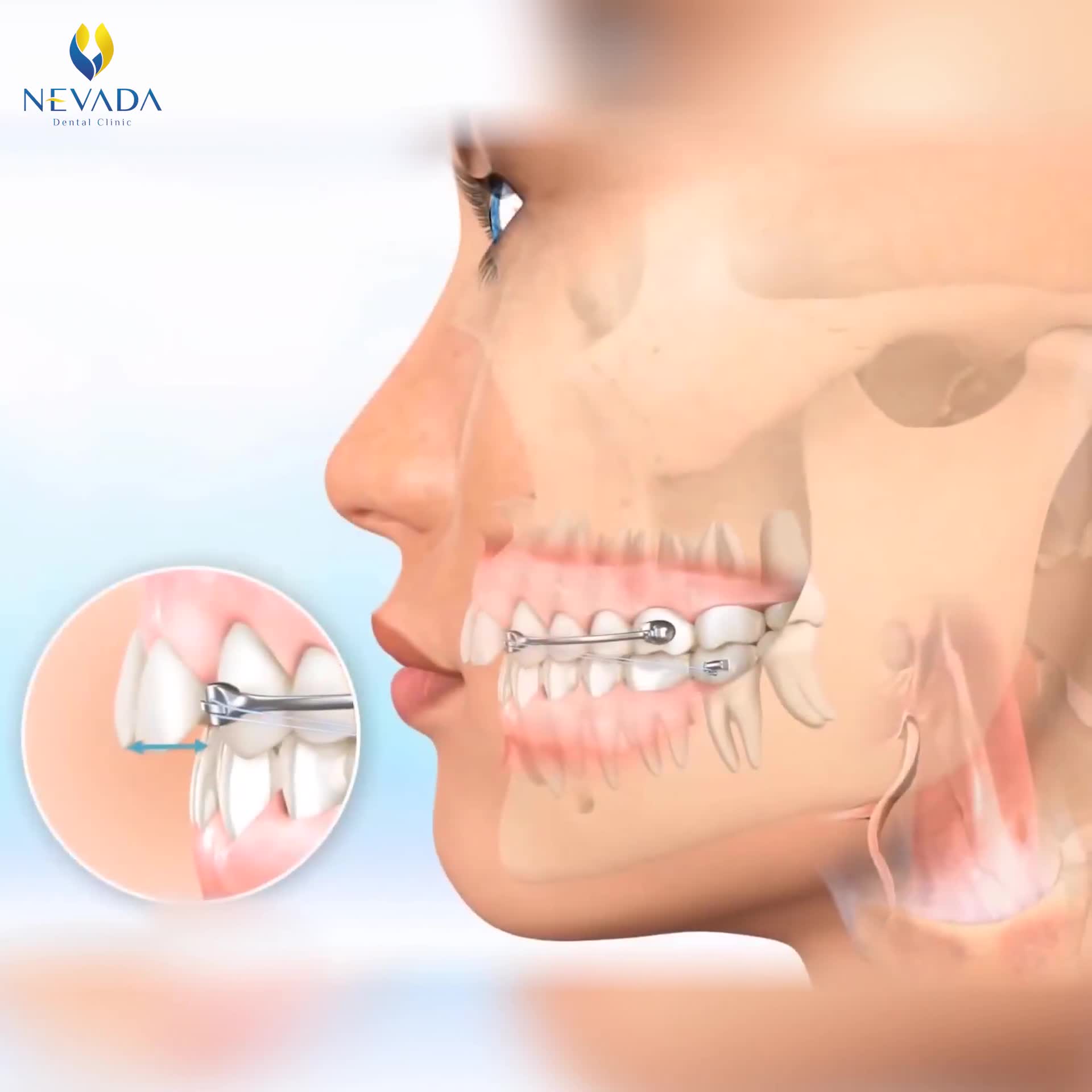 NIỀNG RĂNG - GIẢI PHÁP CHO NỤ CƯỜI TỎA NẮNG