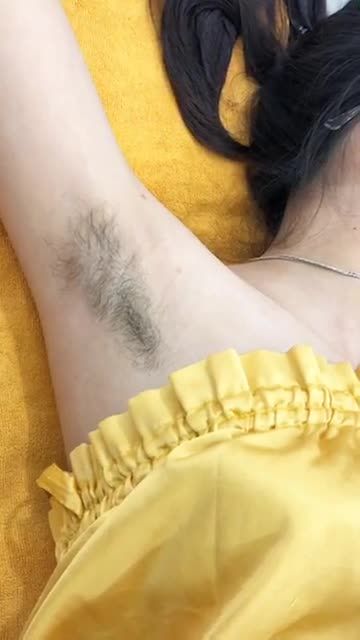 Diode Laser - Triệt sạch lông nách - Hiệu quả vĩnh viễn