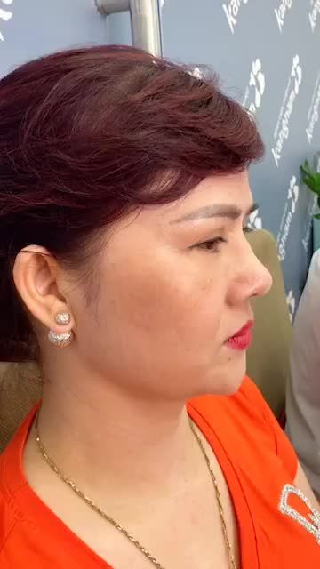 Dị ứng chất liệu sau lần đầu nâng mũi dẫn đến "sụp mũi" nhiều năm