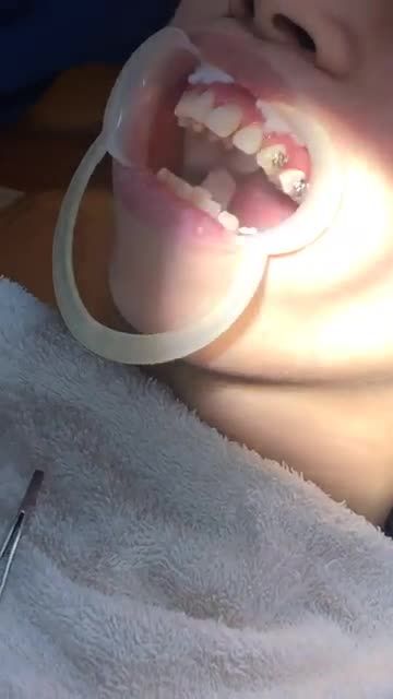 GẮN MẮC CÀI HÔ + HỞ LỢI tại Nha Khoa Vân Anh