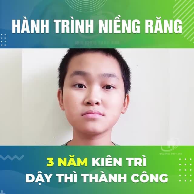 NIỀNG RĂNG 3 NĂM MỘT HÀNH TRÌNH…
