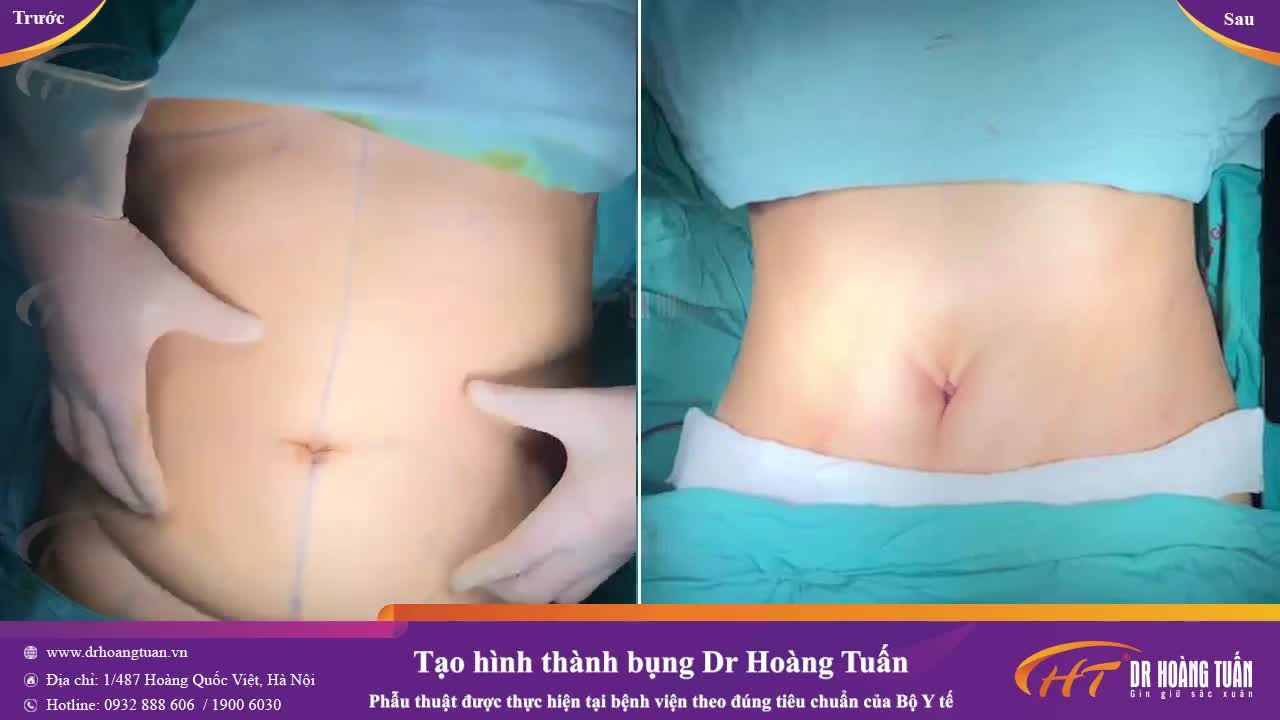 "Sóng mỡ" đã được loại bỏ - Tìm lại bụng phẳng eo thon