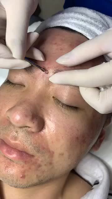 Quy trình trị mụn bọc, mủ, sưng viêm...phức tạp tại Kangnam