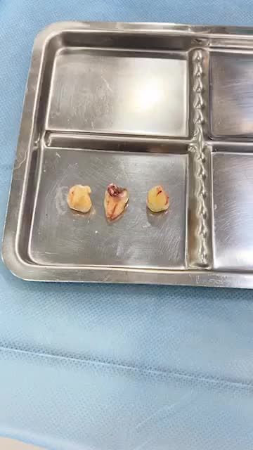 Chỉ mất 3 phút cho 3 chiếc răng khôn mọc lệch khiến khách hàng đau nhức, sưng má nhiều ngày.