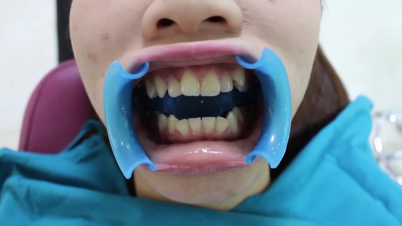 TẠI SAO SAU KHI NIỀNG RĂNG NÊN ĐEO HÀM DUY TRÌ