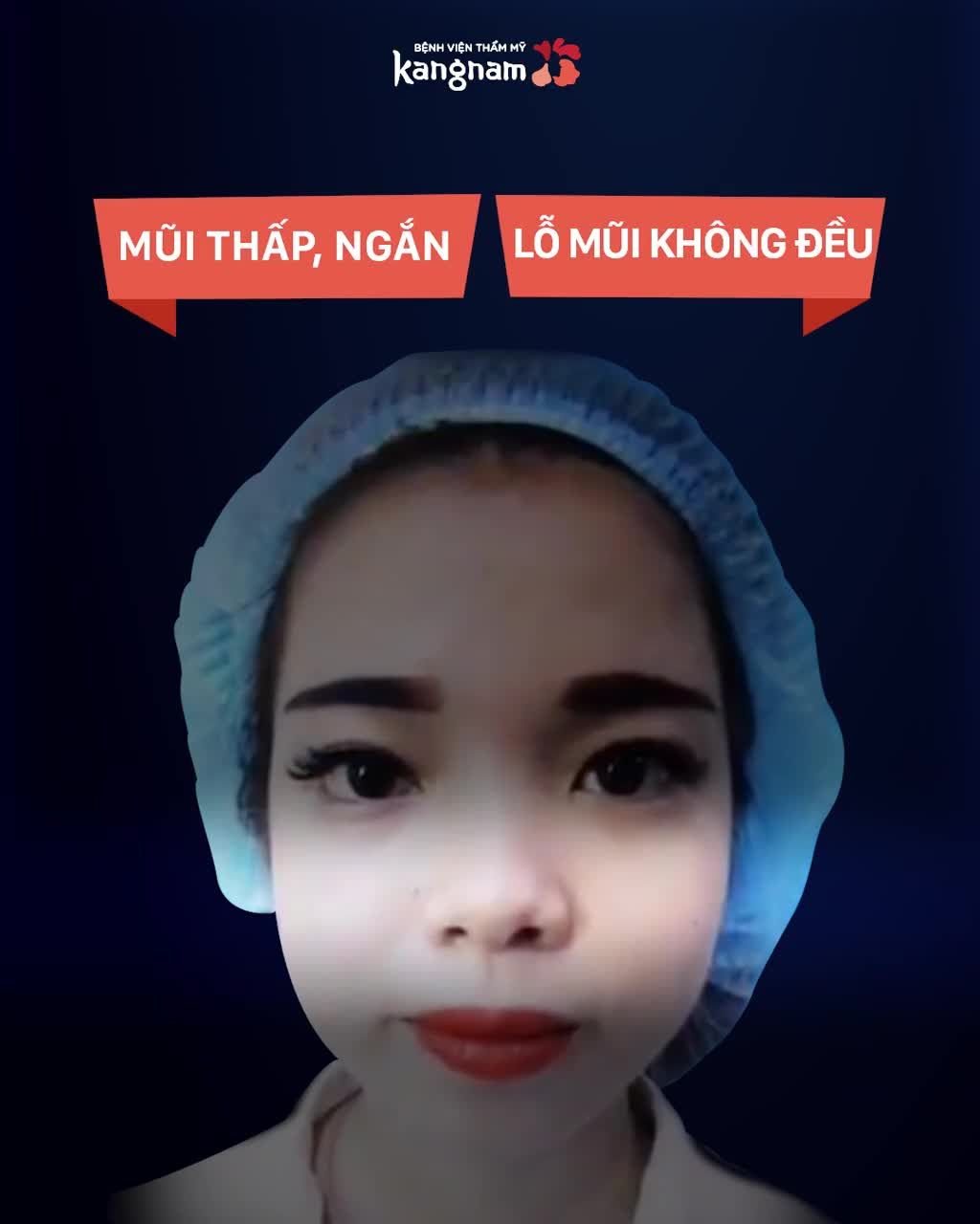 OFF 30% + Tặng 1 triệu Nâng mũi Cấu trúc 4D