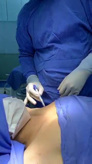 Quy trình chiếu sáng - hút tuyến tại BVTM Kangnam