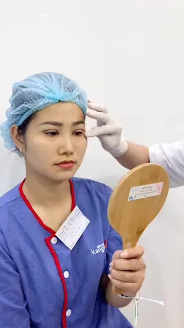 Kết quả cắt mí tại kangnam - chỉ sau 30p mí mắt đẹp như mơ