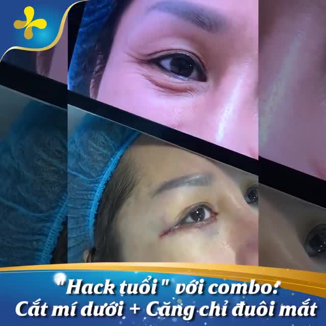 “Ăn gian” tuổi tác cho đôi mắt sau 60 phút cắt mí dưới và căng chỉ đuôi mắt.