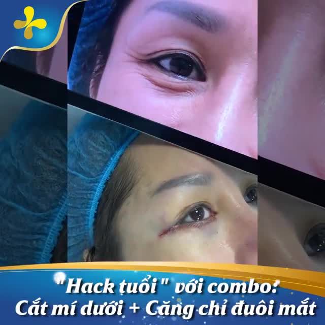 “Ăn gian” tuổi tác cho đôi mắt sau 60 phút cắt mí dưới và căng chỉ đuôi mắt.